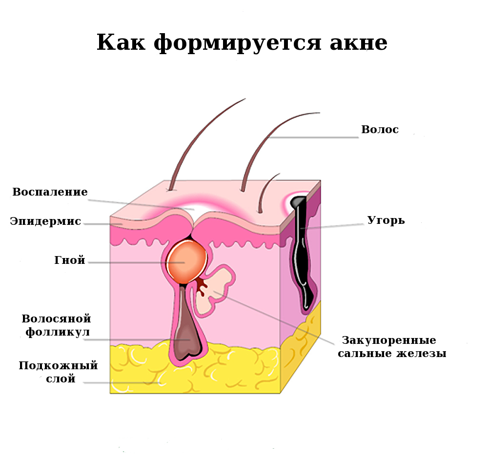 Схема акне