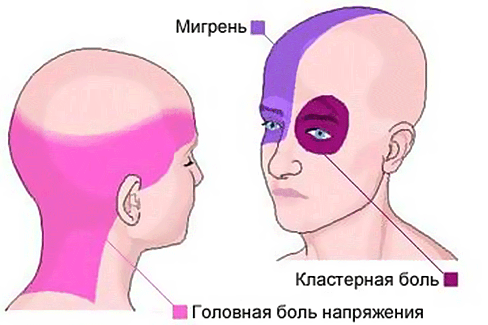 Цефалгия