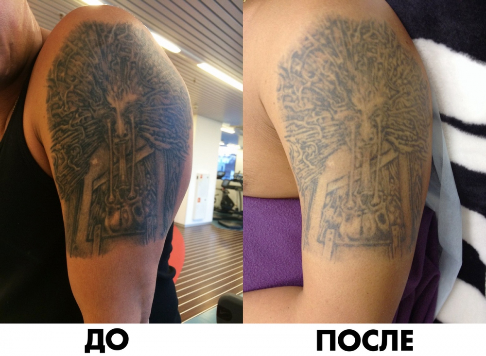 Эффективный метод удаления татуировки