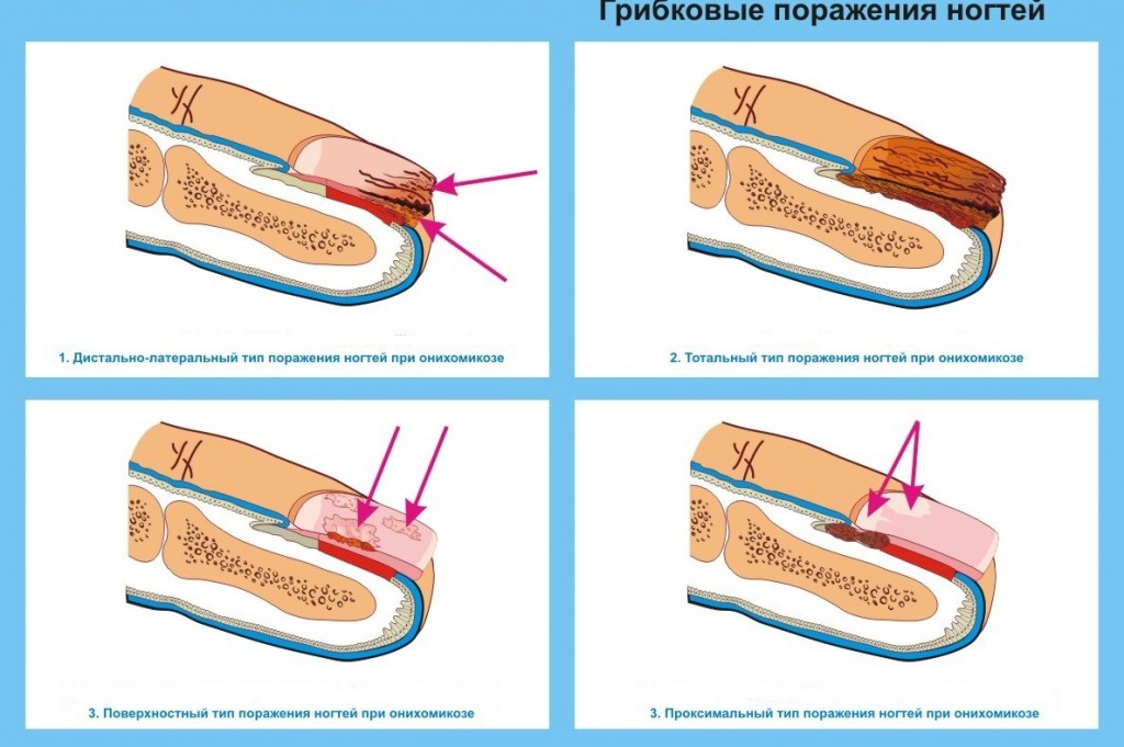 Грибковые поражения
