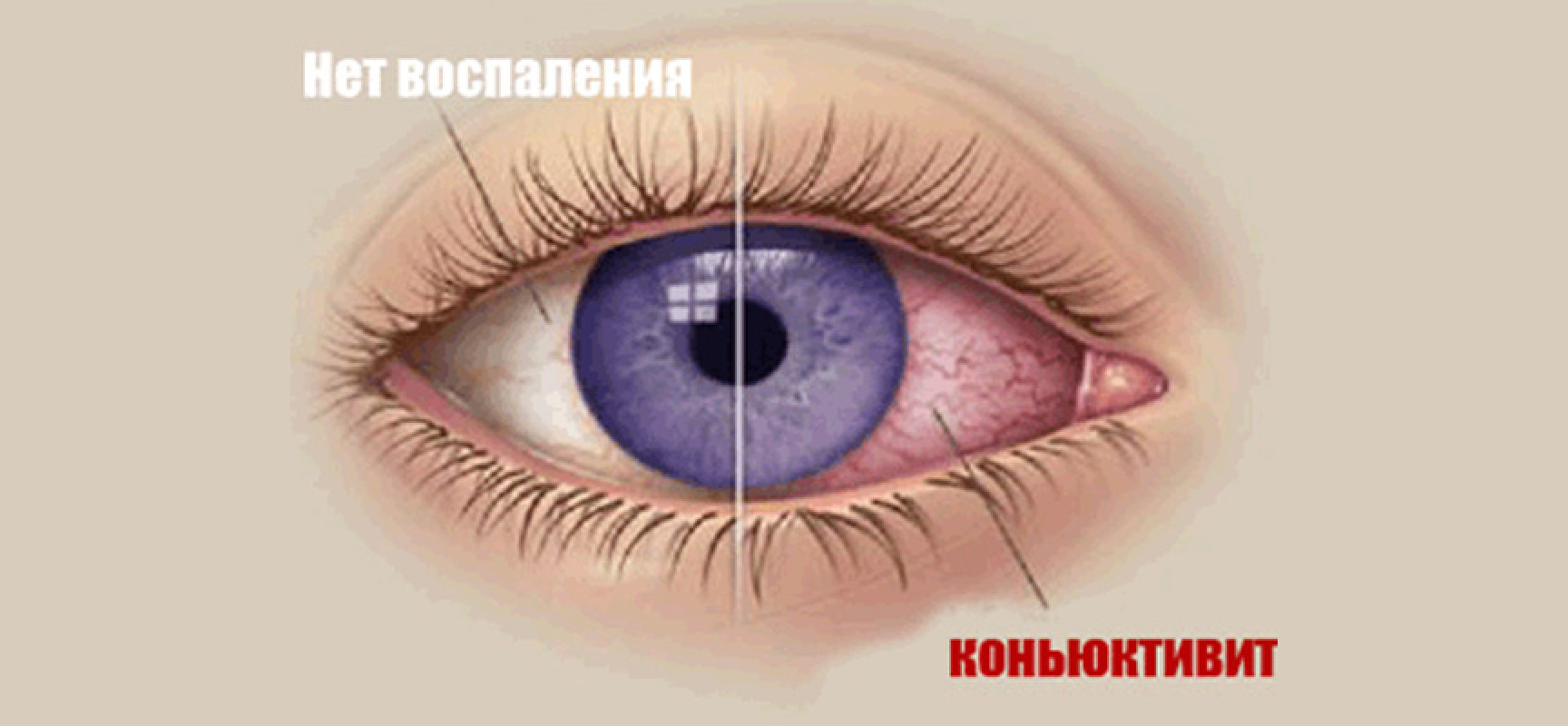 Конъюктивит