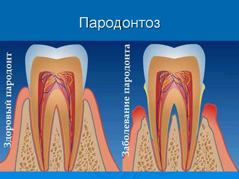 Пародонтоз