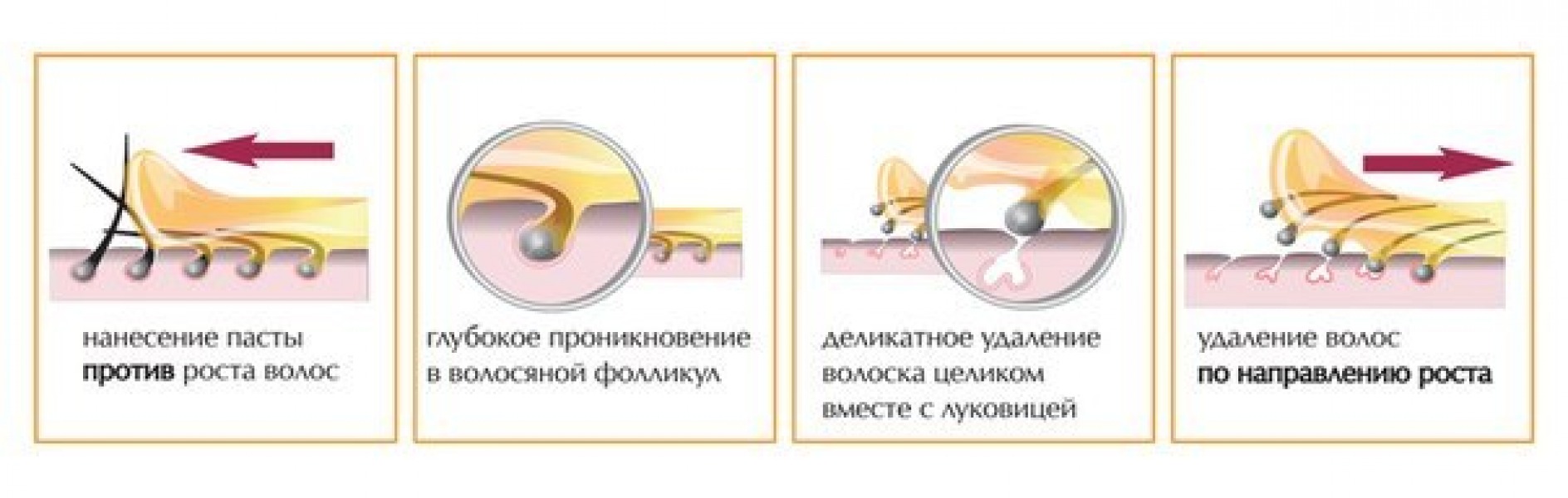 Процесс шугаринга бикини