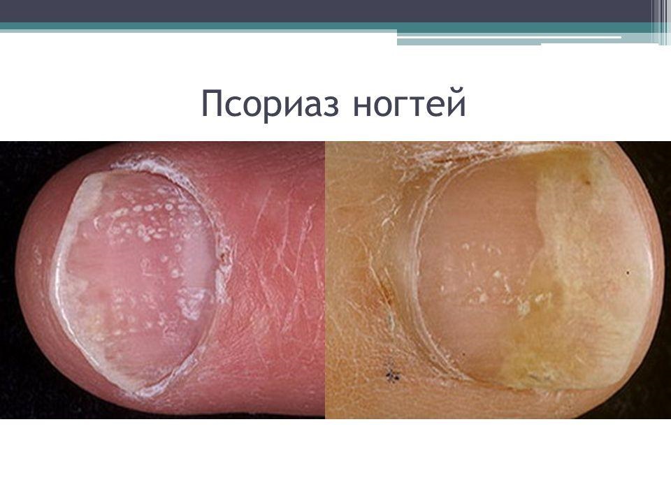 Псориаз