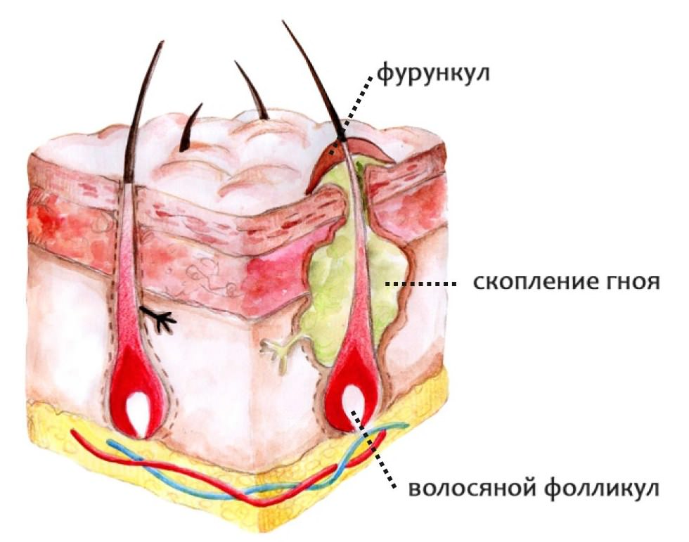 Схема фурункула
