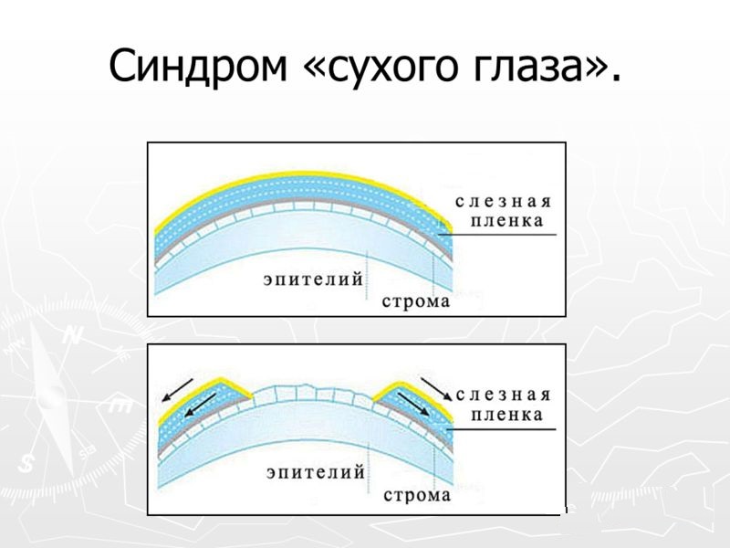 Синдром «сухого глаза».